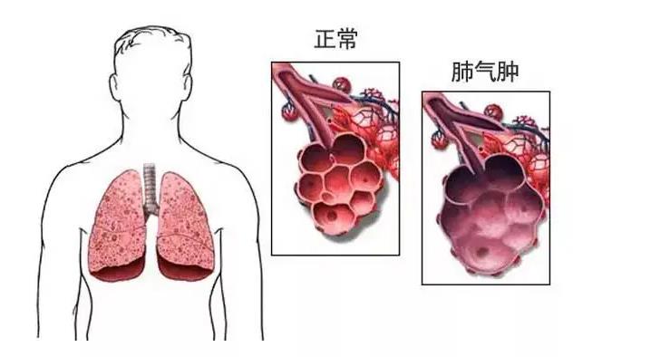 肺氣腫飲還原水